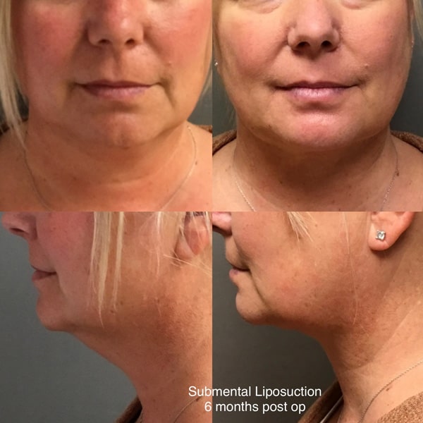 Liposuction before after image