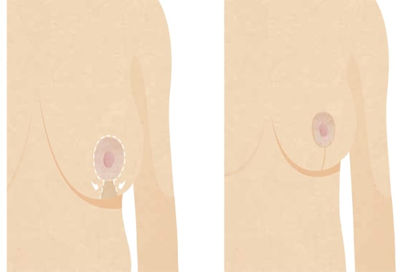Breast Reduction Keyhole Surgery in Surrey