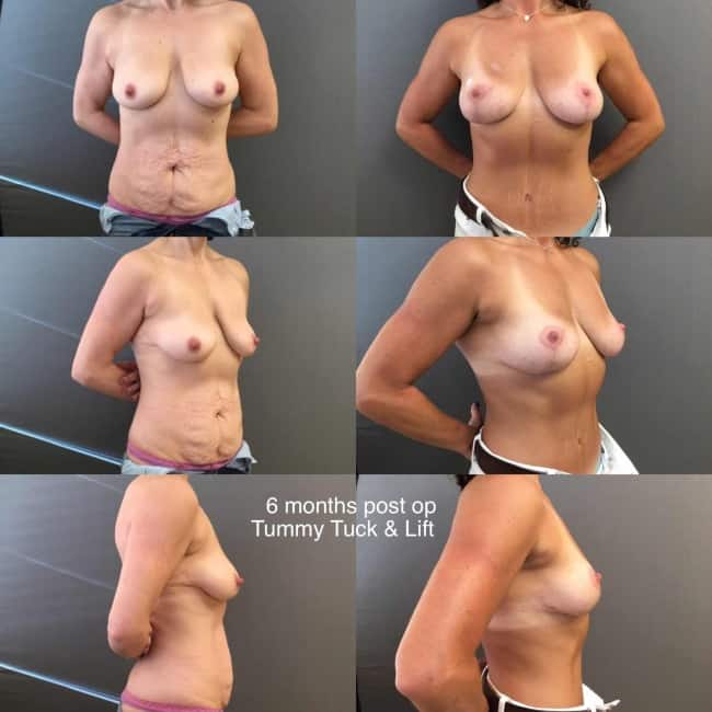 Women tummy tuck and breast