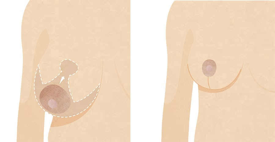 Breast Lift Inverting Services in Surrey, BC